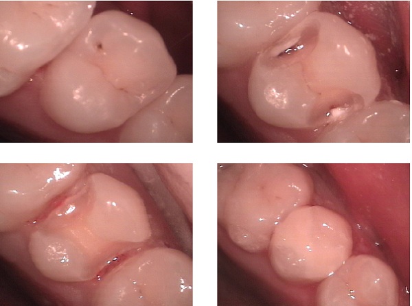 types of fillings